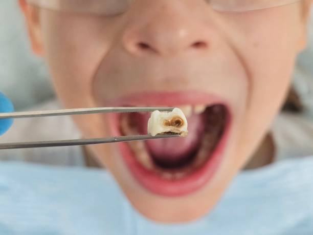 Best Broken or Cracked Tooth Emergency Dentist in Lewistown, MT